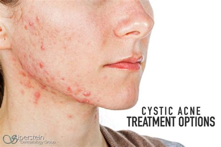 Best cystic acne treatment - How To Discuss