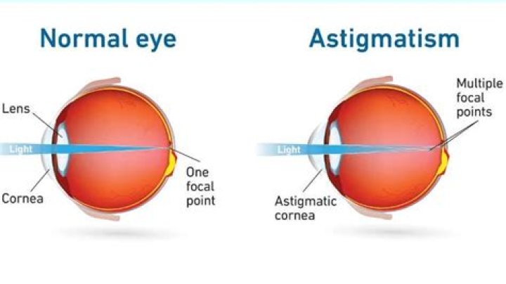 Can Astigmatism Get Worse - How To Discuss