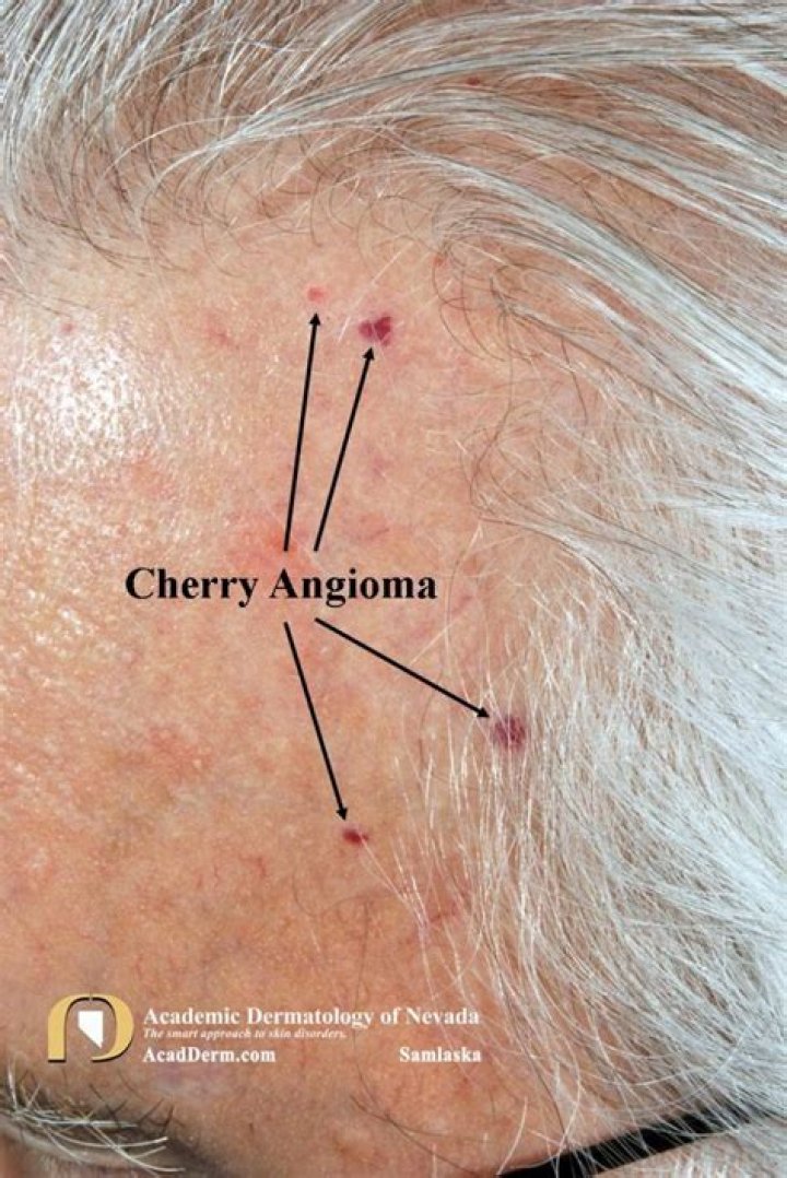 Can Cherry angiomas appear suddenly