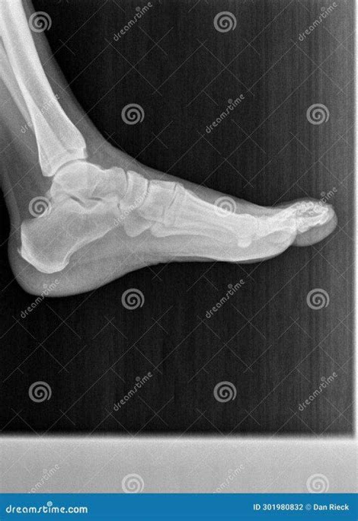 Does foot X ray include ankle