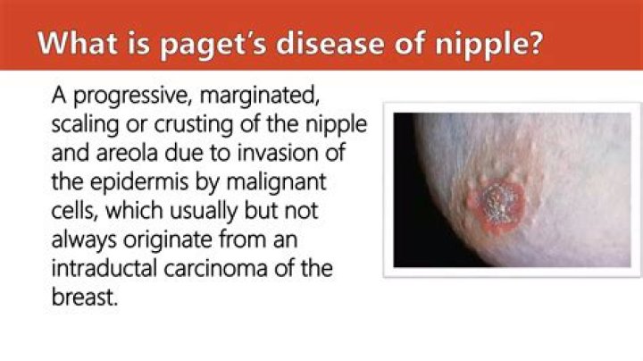 How long can you live with Pagets disease