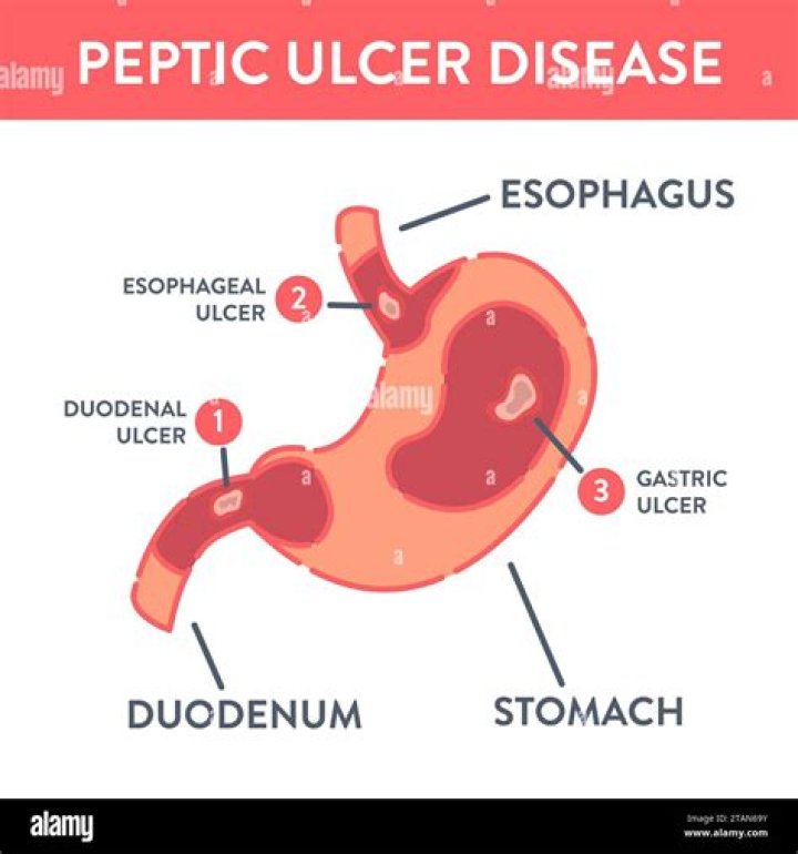 Is duodenal ulcer same as peptic ulcer