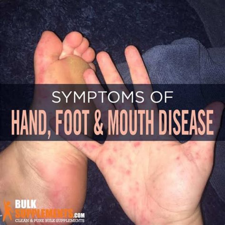 Is Hand Foot and Mouth worse in adults