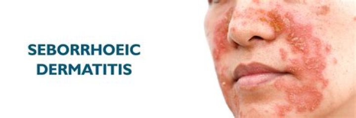 Is seborrheic dermatitis a sign of cancer