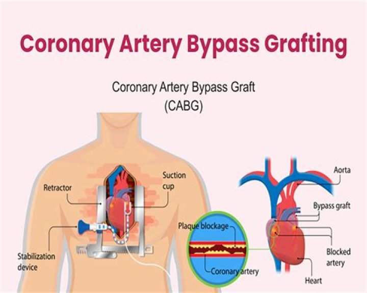 Is the CPT code for a coronary artery bypass using a saphenous vein graft