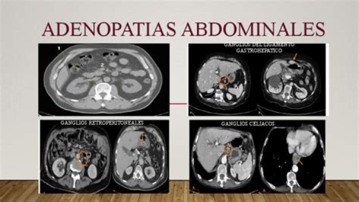 ¿Qué es Adenopatia abdominal