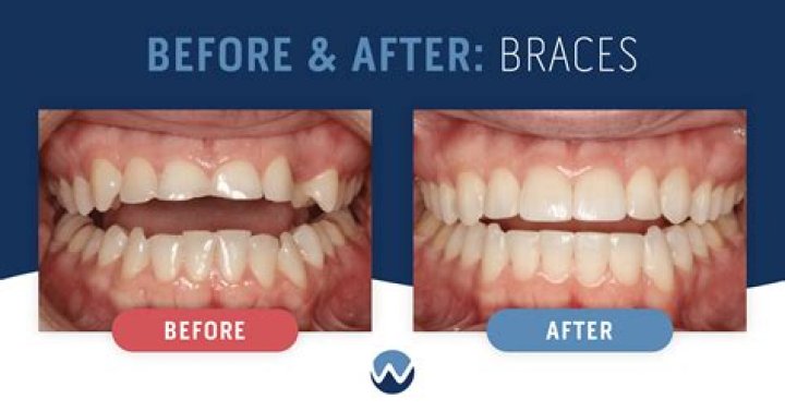Quick Answer: Does Health Choice Az Cover Braces