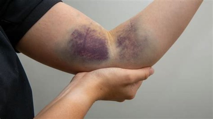 Quick Answer: How To Heal Bruises Faster
