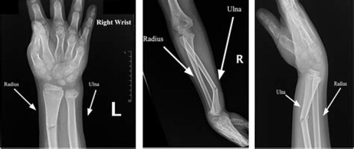 What is a closed reduction of the wrist