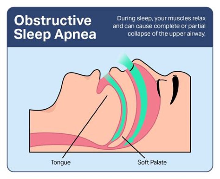 What is another name for sleep apnea