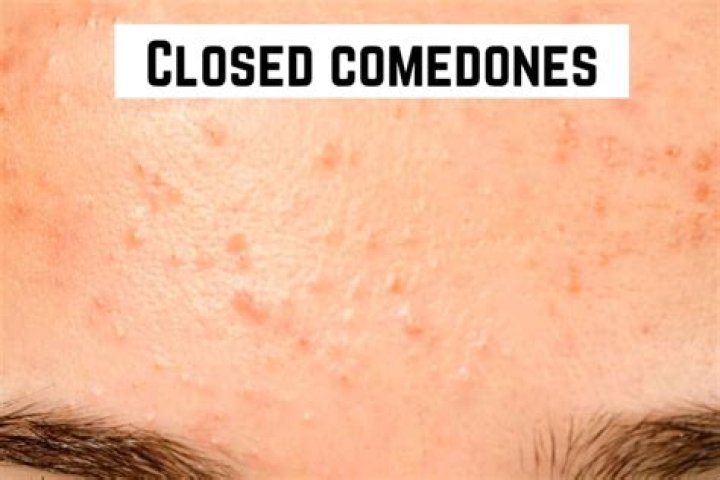 Why do I have closed comedones
