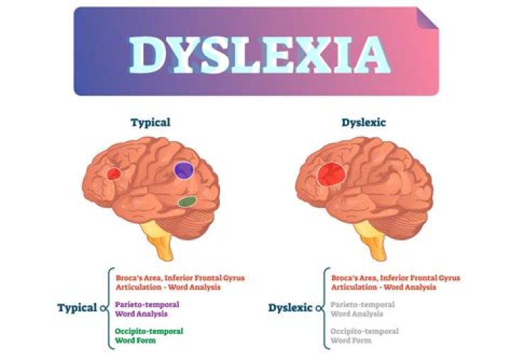Why does dyslexia happen